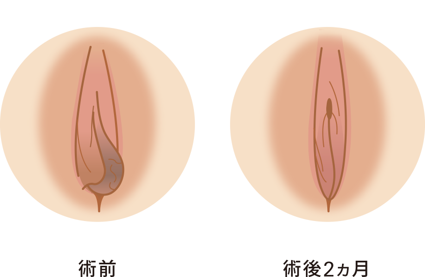 小陰唇縮小セット症例イメージ5