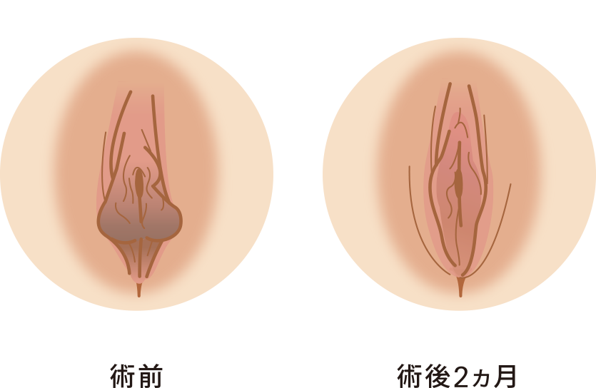 小陰唇縮小セット症例イメージ2(小陰唇縮小+副皮除去+クリトリス包茎)