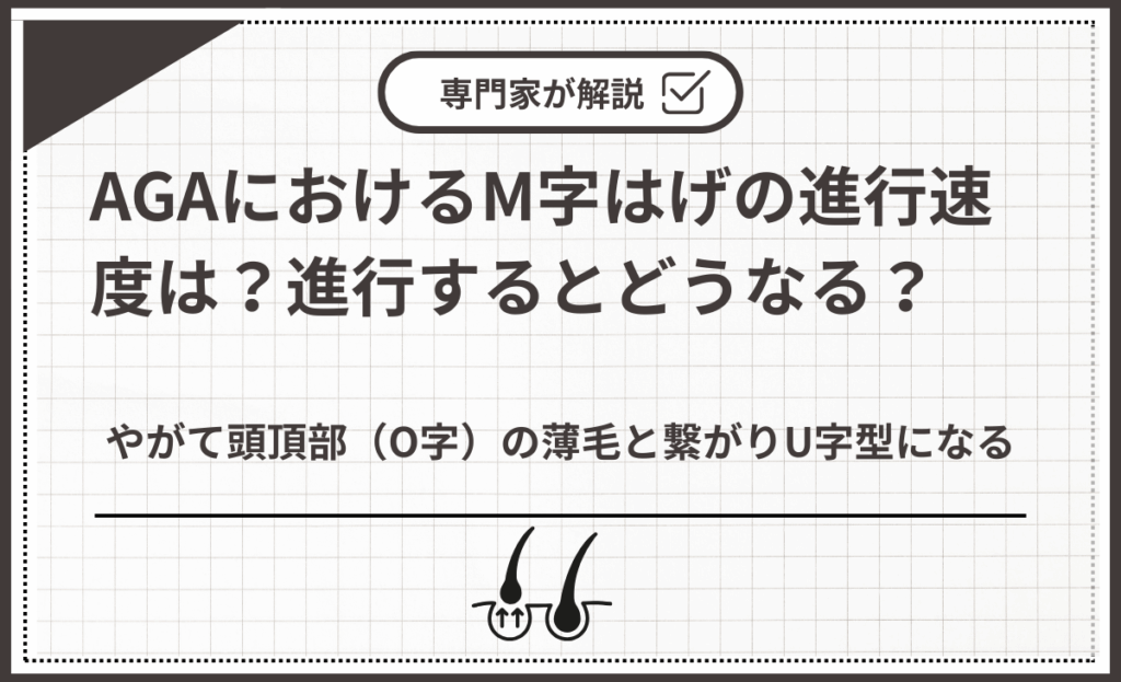 やがて頭頂部（O字）の薄毛と繋がりU字型になる
