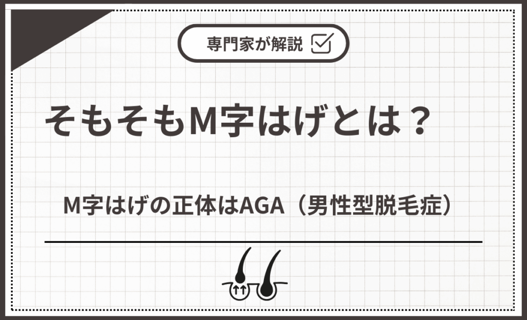 M字はげの正体はAGA（男性型脱毛症）