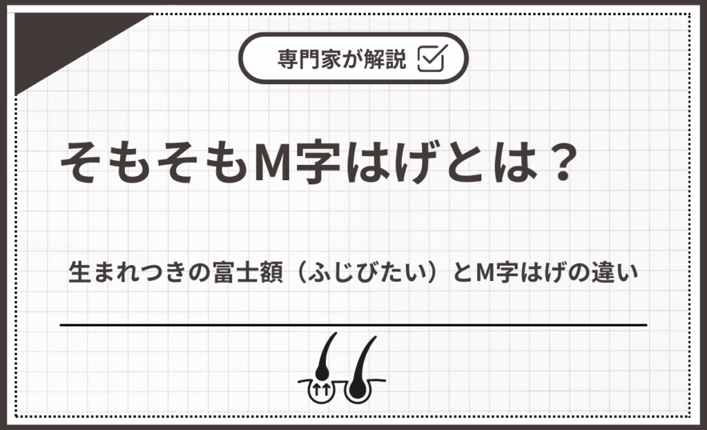 生まれつきの富士額（ふじびたい）とM字はげの違い