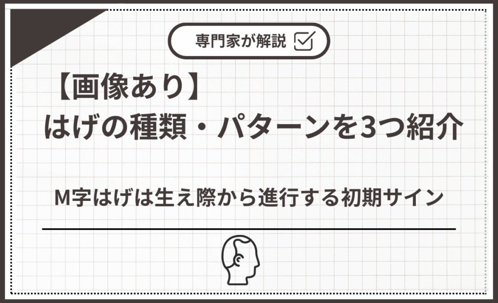 M字はげは生え際から進行する初期サイン