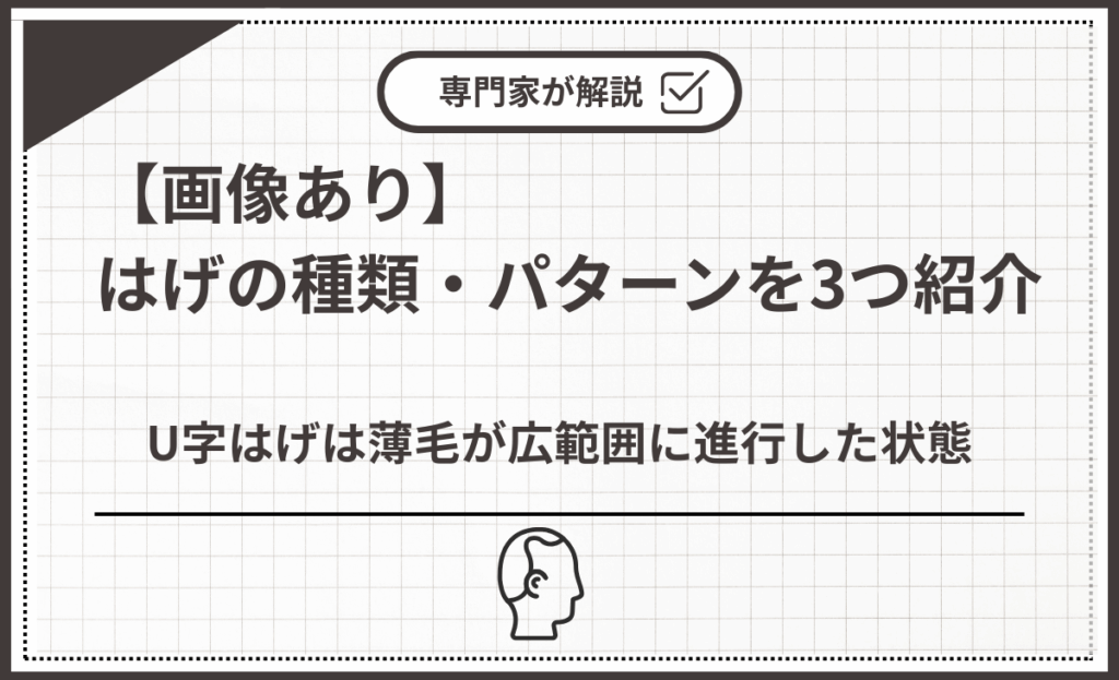 U字はげは薄毛が広範囲に進行した状態