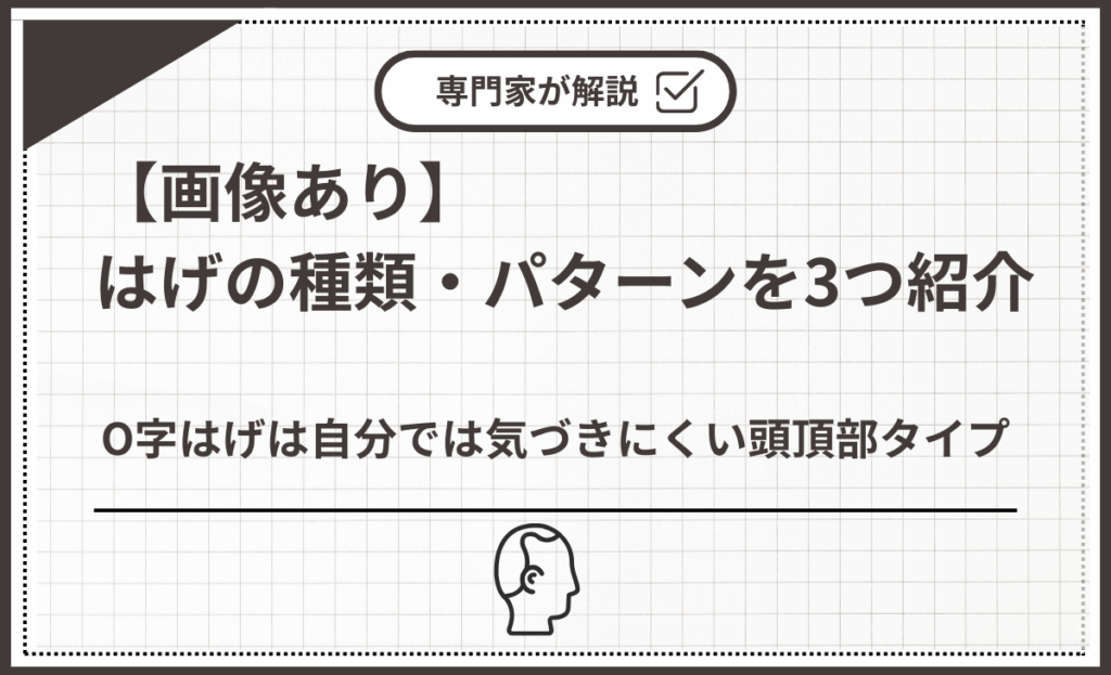 O字はげは自分では気づきにくい頭頂部タイプ