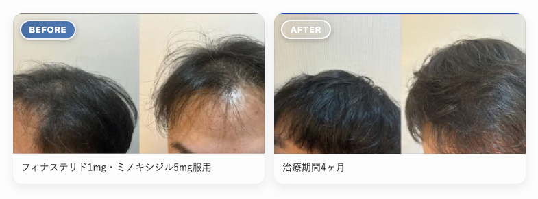 レバクリの発毛プランの施術前と施術後の症例写真をまとめた画像