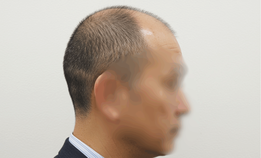 U字はげに悩む50代男性