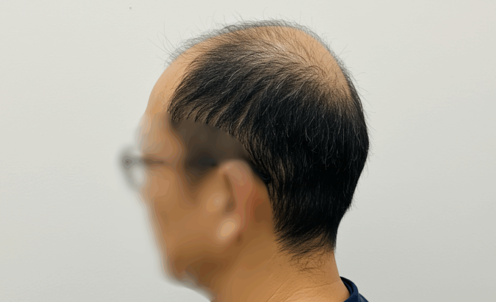 O字はげに悩む50代男性