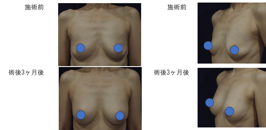 LipoLife豊胸の症例写真1