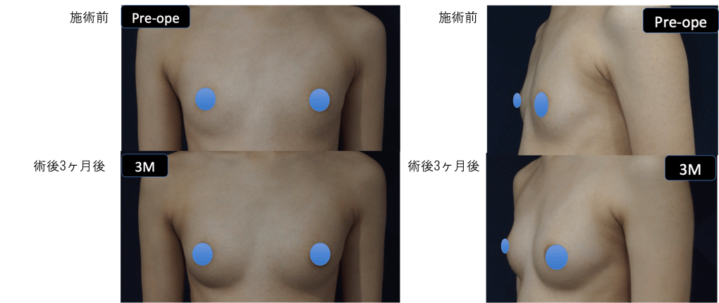 LipoLife豊胸術の症例写真１