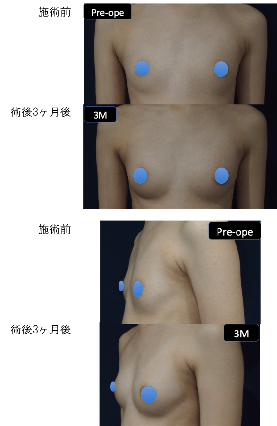 LipoLife豊胸術の症例写真１
