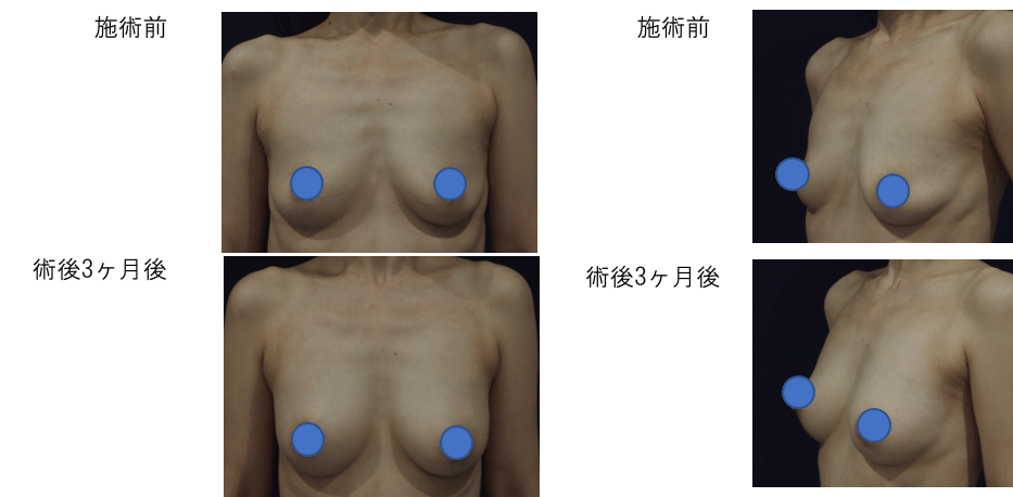 複数回施術の症例写真1