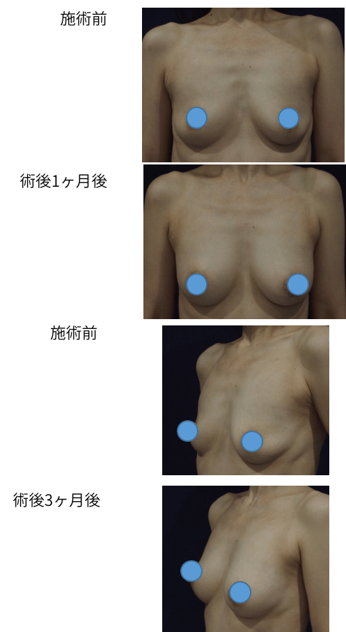 複数回施術の症例写真1