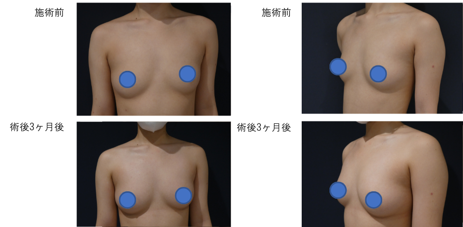 ピュアグラフト豊胸 ピュアグラフトNB（内内前）のビフォー・アフター症例その１ | 施術前から3ヶ月後の経過観察(PC版)