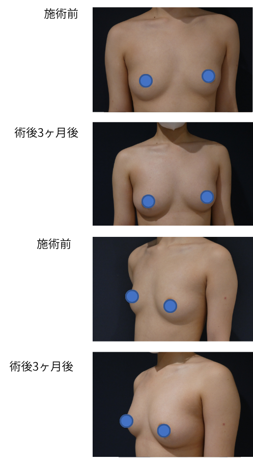 ピュアグラフト豊胸 ピュアグラフトNB（内内前）のビフォー・アフター症例その１ | 施術前から3ヶ月後の経過観察(SP版)