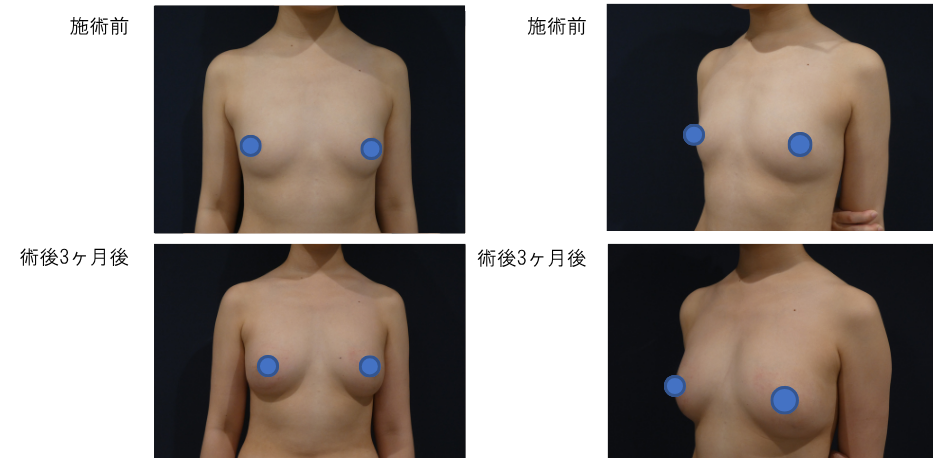 ピュアグラフト豊胸 ピュアグラフトNB（外後臀）のビフォー・アフター症例その4 | 施術前から３ヶ月後の経過観察(PC版)