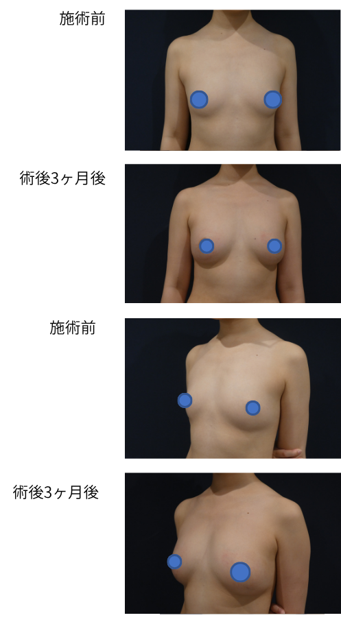 ピュアグラフト豊胸 ピュアグラフトNB（外後臀）のビフォー・アフター症例その4 | 施術前から３ヶ月後の経過観察(SP版)