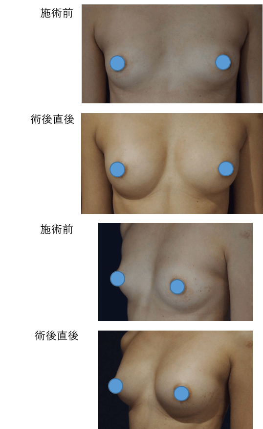 複数回施術の症例写真3
