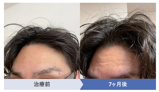 30代でM字はげに悩む方が7か月治療をした治療前と治療後の症例画像