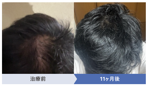 40代でO字はげに悩む方が11か月治療をした治療前と治療後の症例画像