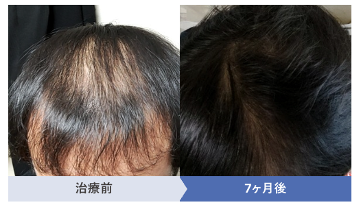 40代でU字はげに悩む方が7か月治療をした治療前と治療後の症例画像