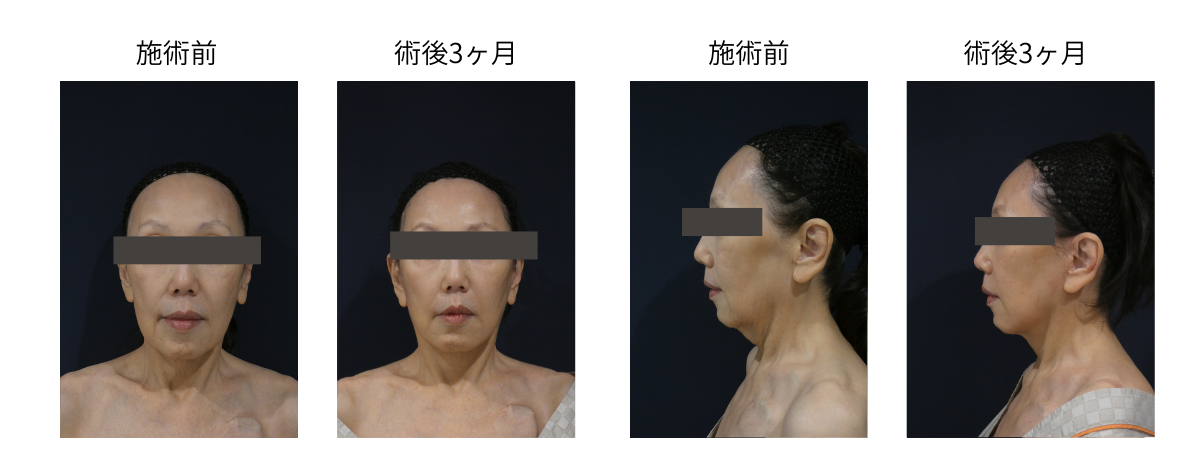 Deep planeフェイスリフトの症例写真1