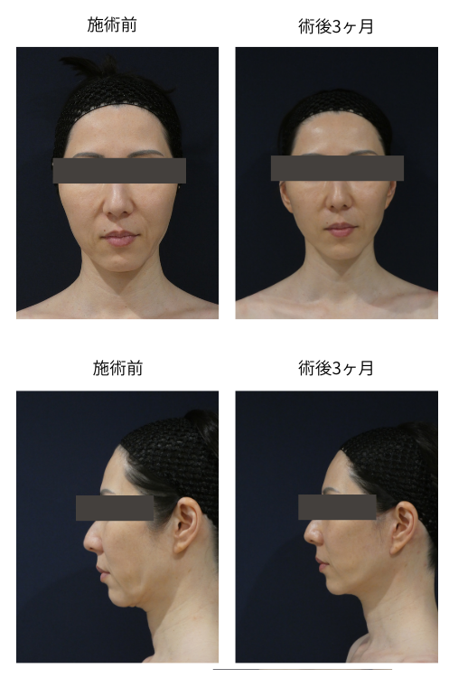 SMASリガメント法フェイスリフトの症例写真1