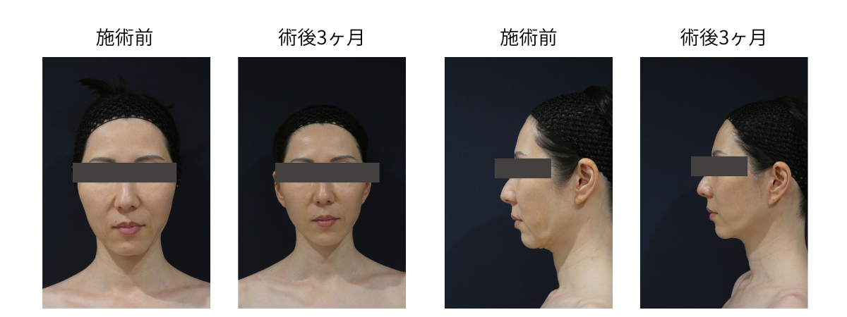 SMASリガメント法フェイスリフトの症例写真1