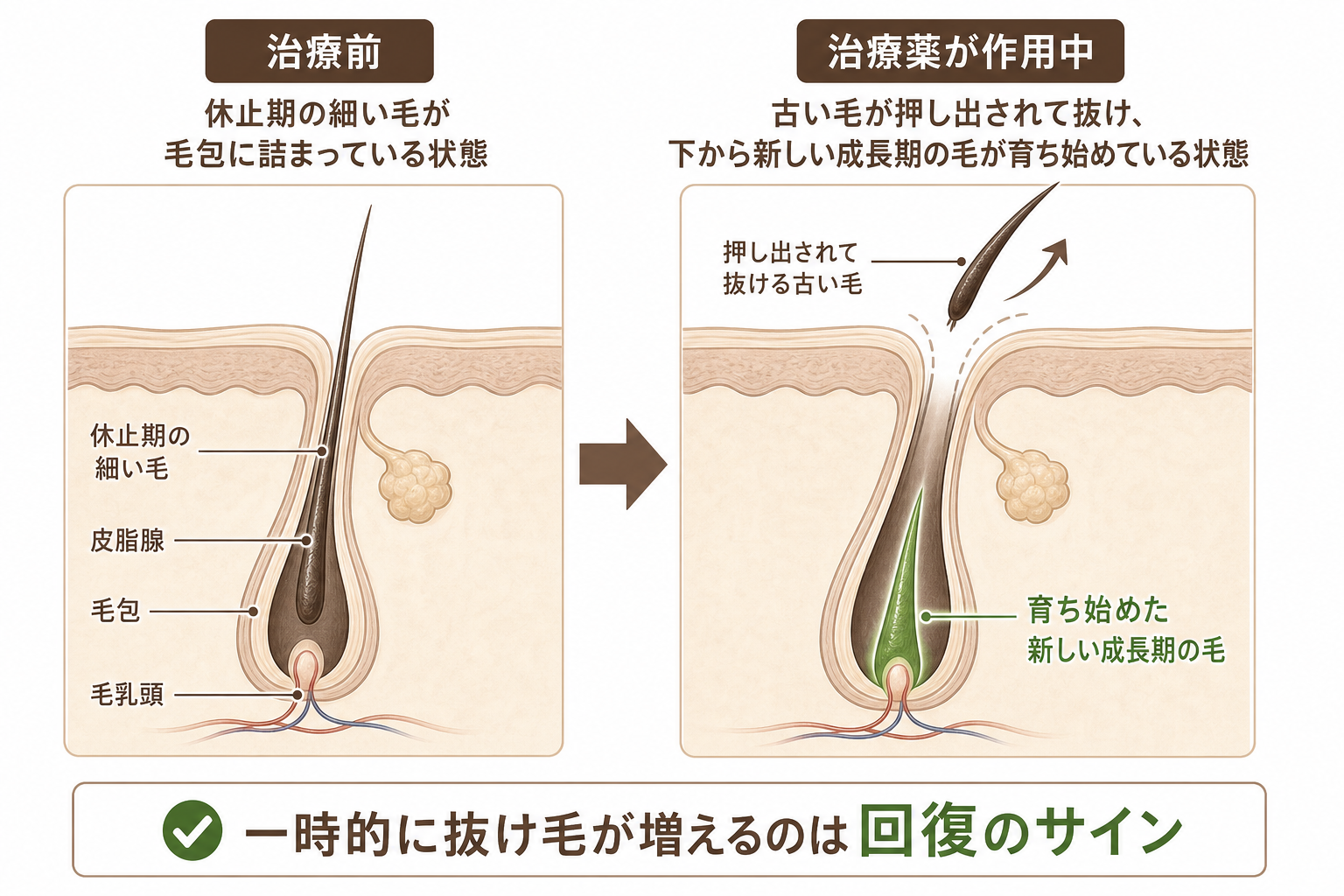 初期脱毛の仕組みイラスト