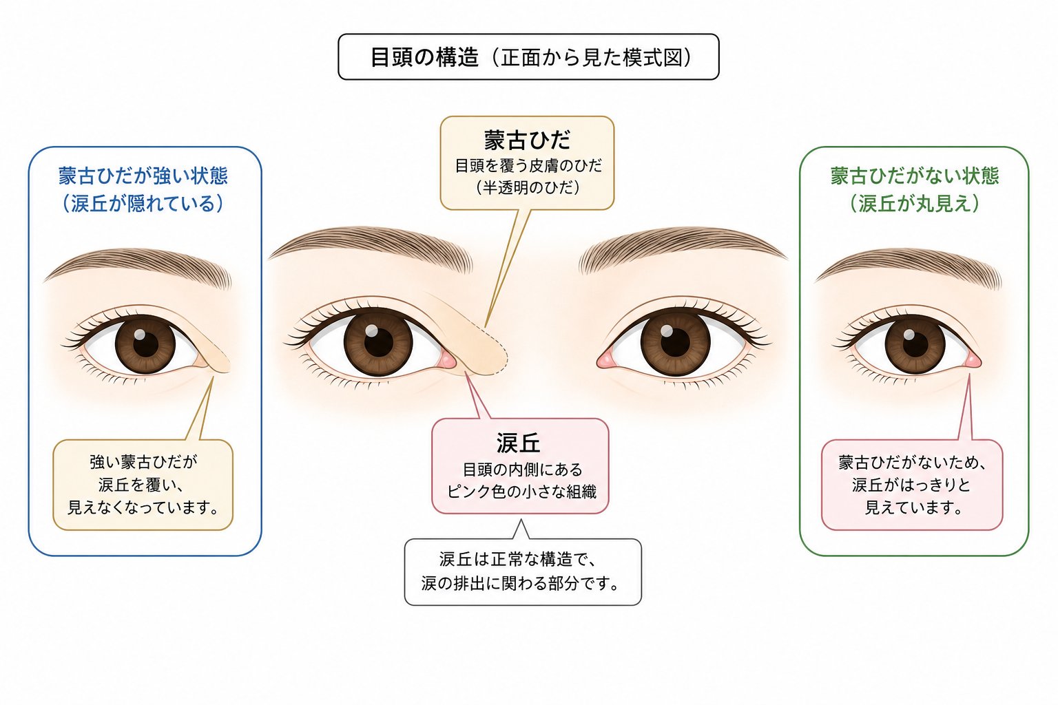 蒙古ひだがもともと少ない・ほぼない人