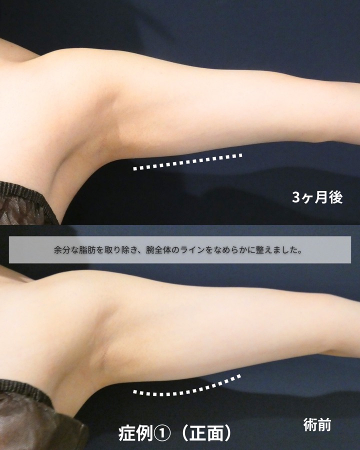 S.T styleクリニックの脂肪吸引（両二の腕・両腕付け根） 症例写真 2/6
