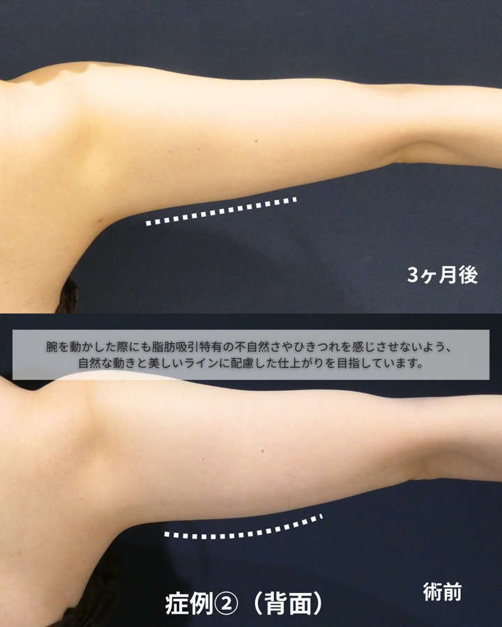 S.T styleクリニックの脂肪吸引（両二の腕・両腕付け根） 症例写真 3/6