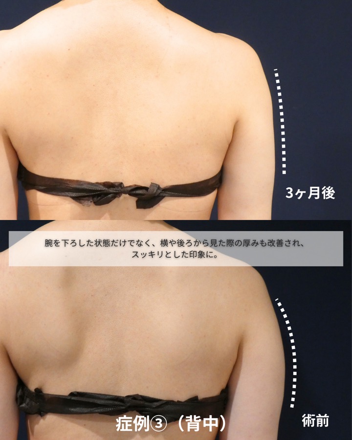S.T styleクリニックの脂肪吸引（両二の腕・両腕付け根） 症例写真 4/6