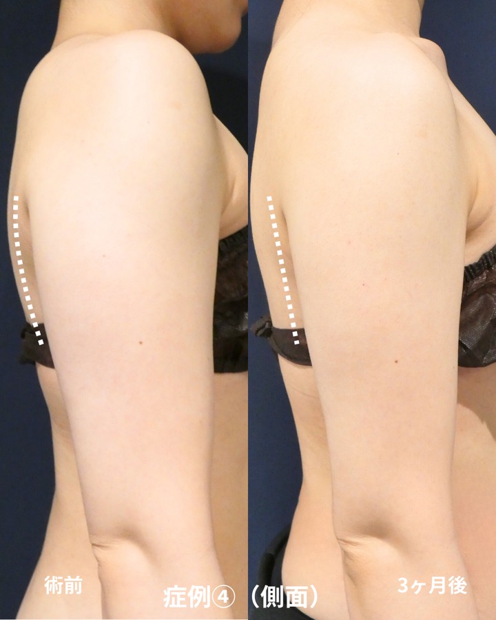 S.T styleクリニックの脂肪吸引（両二の腕・両腕付け根） 症例写真 5/6