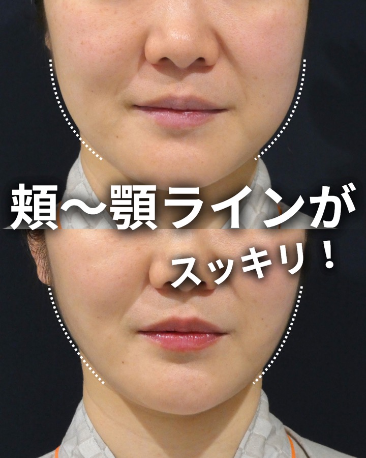 S.T styleクリニックのほほアゴ脂肪吸引＋糸リフトアップ 症例写真 1/7