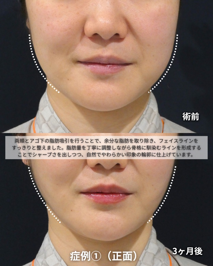 S.T styleクリニックのほほアゴ脂肪吸引＋糸リフトアップ 症例写真 4/7