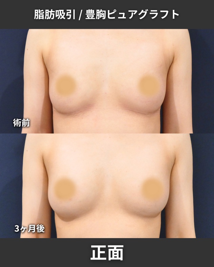 S.T styleクリニックのピュアグラフト豊胸術＋脂肪吸引（太もも全周・臀部） 症例写真 2/8