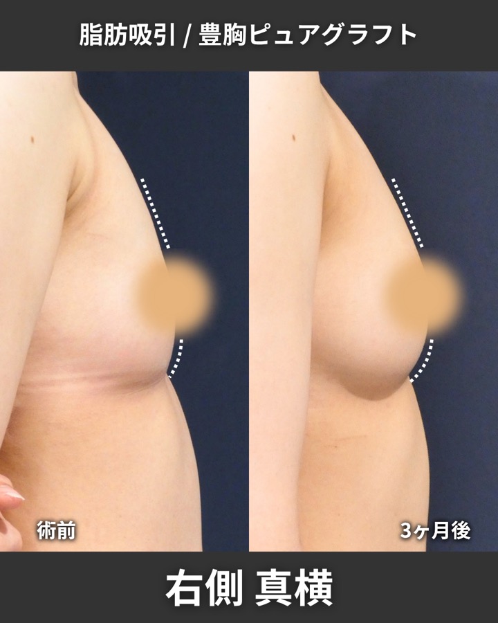 S.T styleクリニックのピュアグラフト豊胸術＋脂肪吸引（太もも全周・臀部） 症例写真 5/8