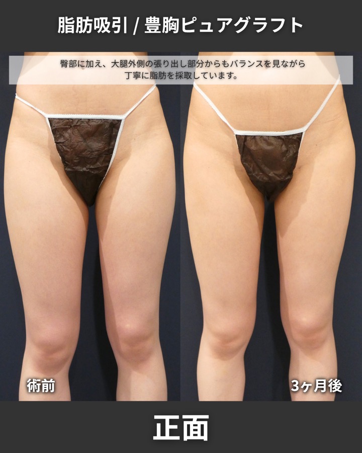 S.T styleクリニックのピュアグラフト豊胸術＋脂肪吸引（太もも全周・臀部） 症例写真 6/8