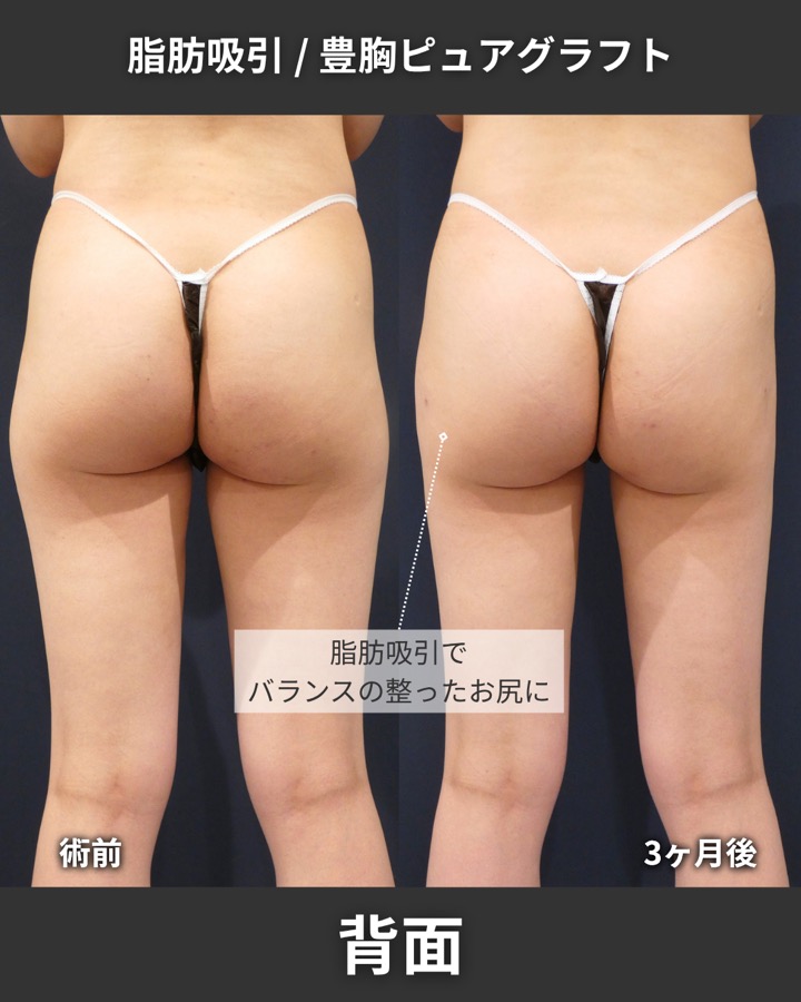 S.T styleクリニックのピュアグラフト豊胸術＋脂肪吸引（太もも全周・臀部） 症例写真 7/8