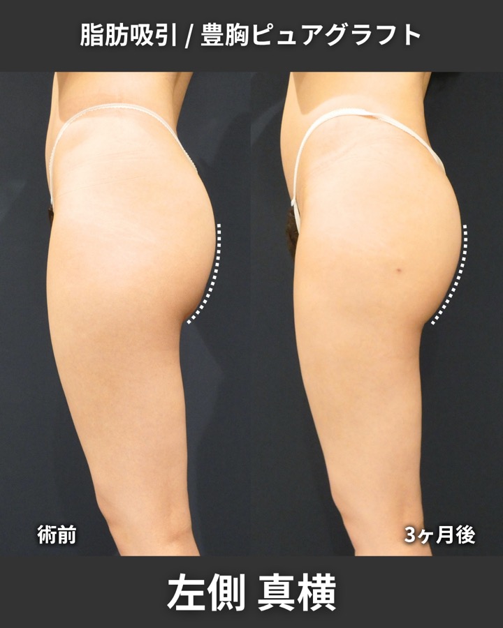 S.T styleクリニックのピュアグラフト豊胸術＋脂肪吸引（太もも全周・臀部） 症例写真 8/8