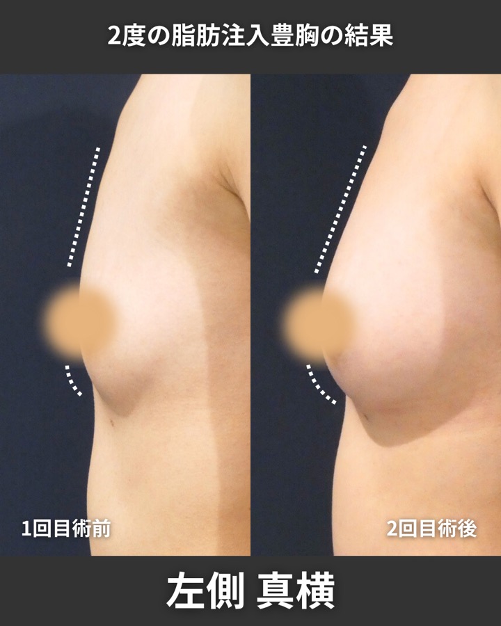 S.T styleクリニックの脂肪注入豊胸（2回目の施術） 症例写真 2/9