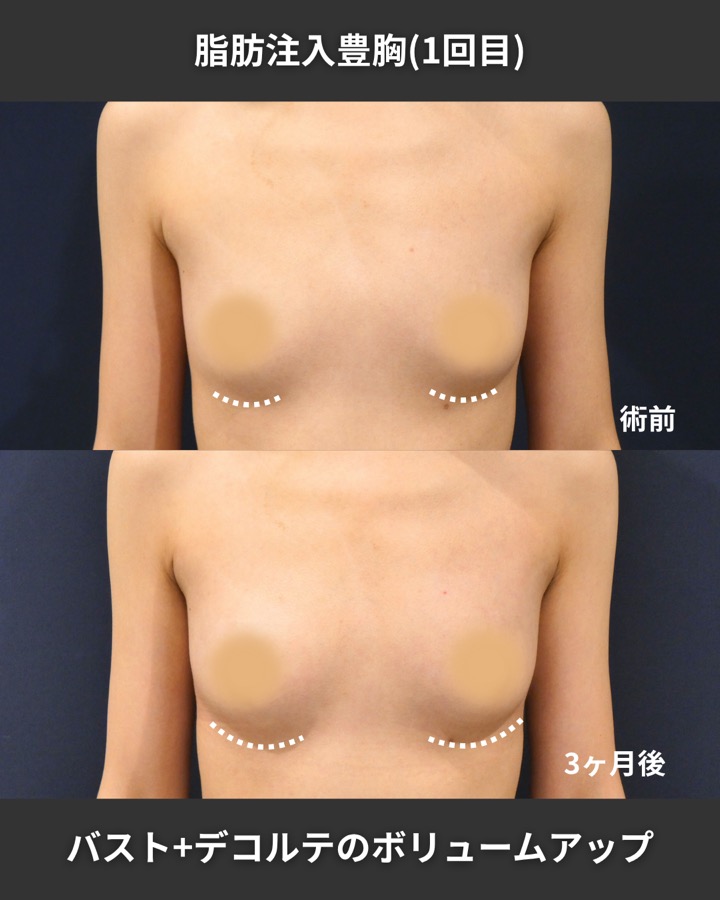 S.T styleクリニックの脂肪注入豊胸（2回目の施術） 症例写真 3/9