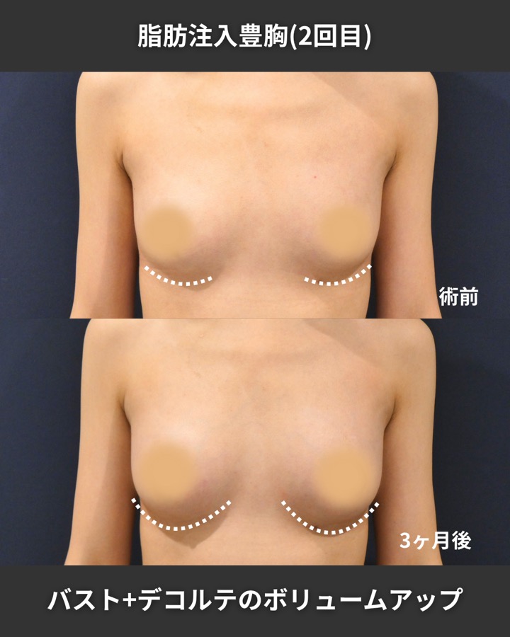 S.T styleクリニックの脂肪注入豊胸（2回目の施術） 症例写真 4/9