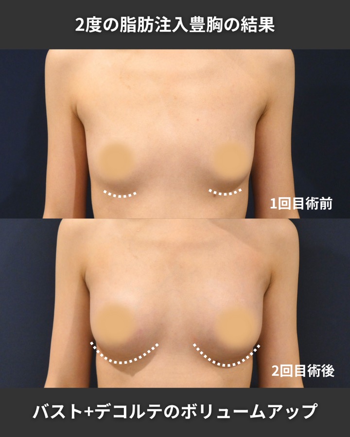 S.T styleクリニックの脂肪注入豊胸（2回目の施術） 症例写真 5/9