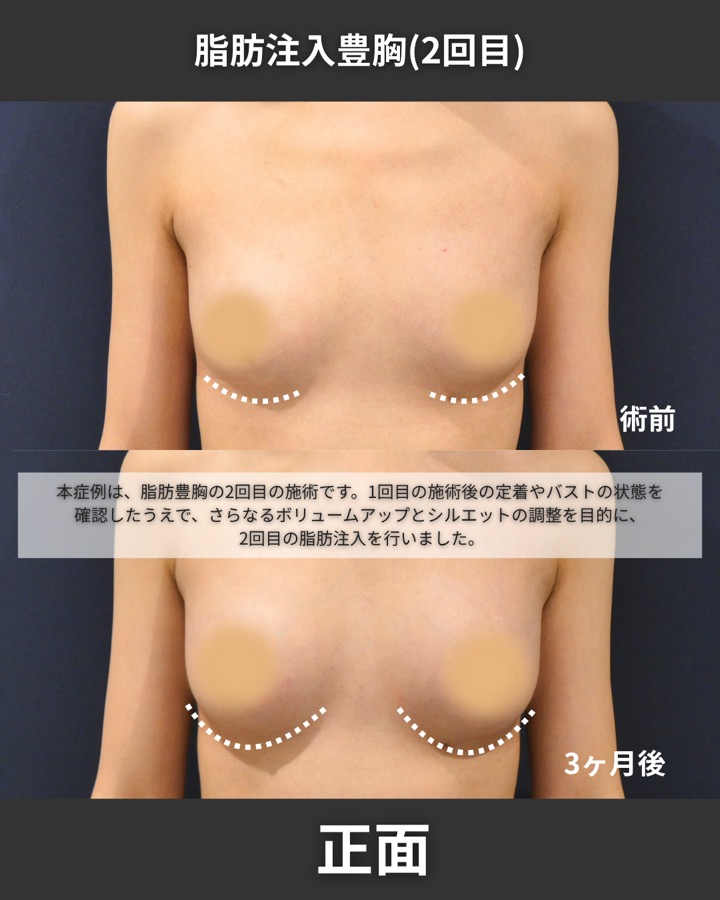 S.T styleクリニックの脂肪注入豊胸（2回目の施術） 症例写真 6/9