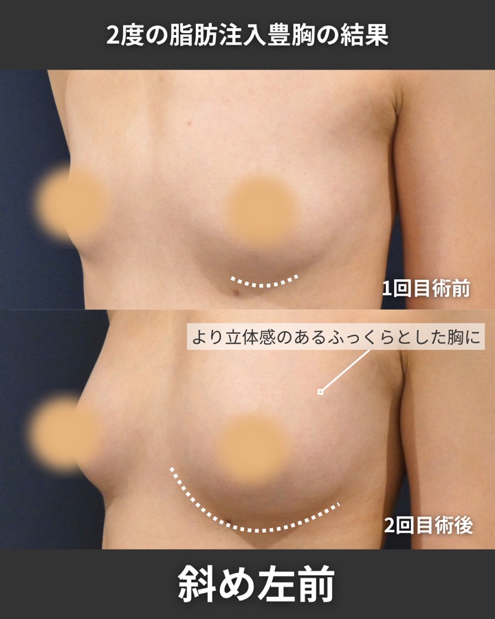 S.T styleクリニックの脂肪注入豊胸（2回目の施術） 症例写真 7/9