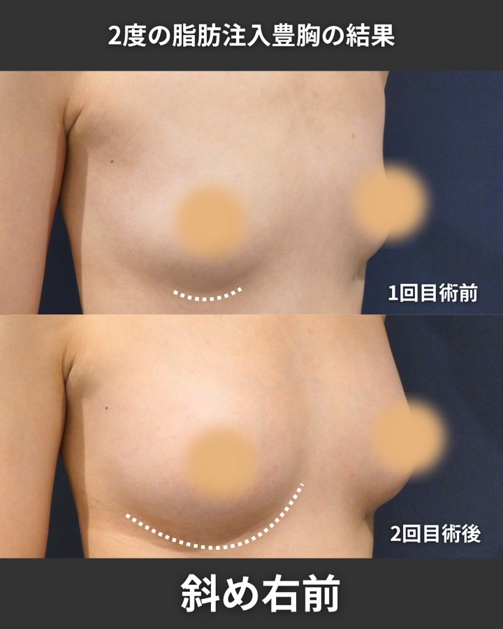 S.T styleクリニックの脂肪注入豊胸（2回目の施術） 症例写真 8/9
