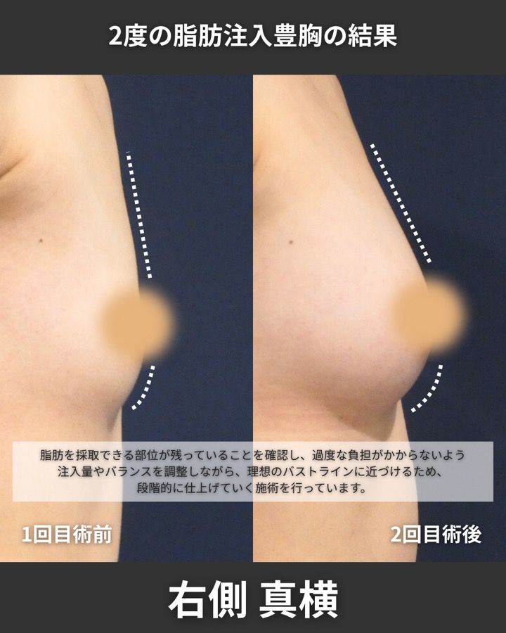 S.T styleクリニックの脂肪注入豊胸（2回目の施術） 症例写真 9/9