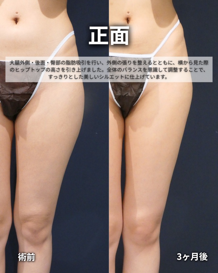 S.T styleクリニックの脂肪吸引（両太もも後側・両太もも外側・臀部） 症例写真 3/7