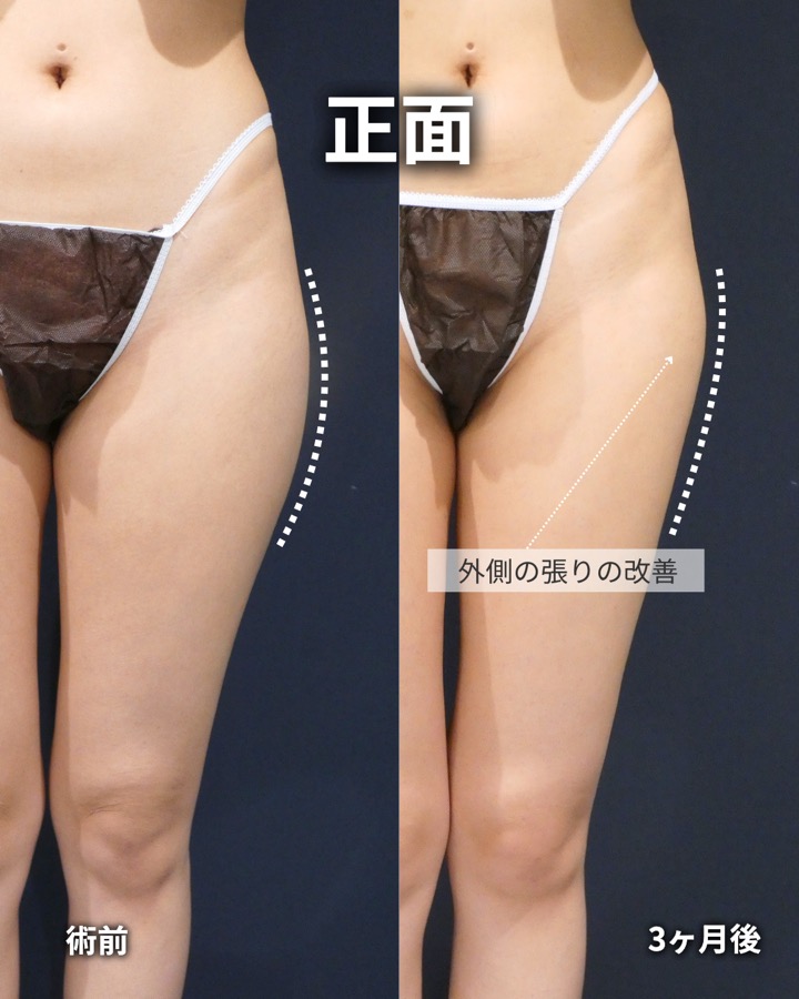 S.T styleクリニックの脂肪吸引（両太もも後側・両太もも外側・臀部） 症例写真 4/7
